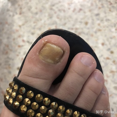脚趾甲增厚是怎么回事