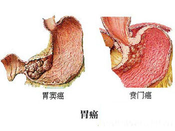 胃癌