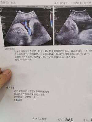 怀孕36周脐带绕颈两周怎么办