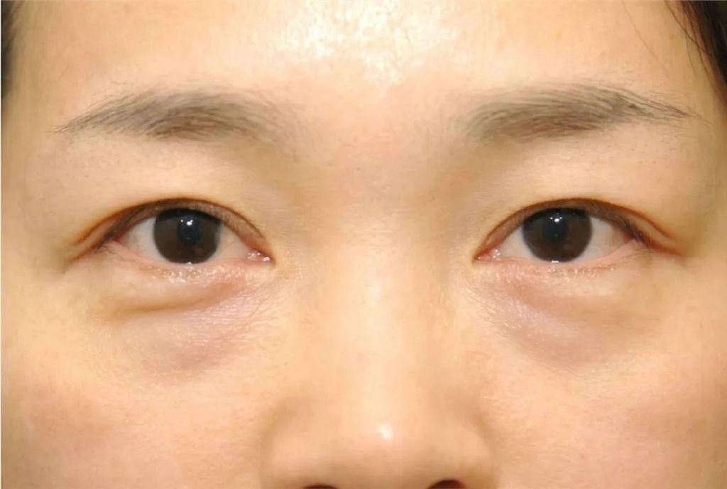 眼袋大是怎么回事