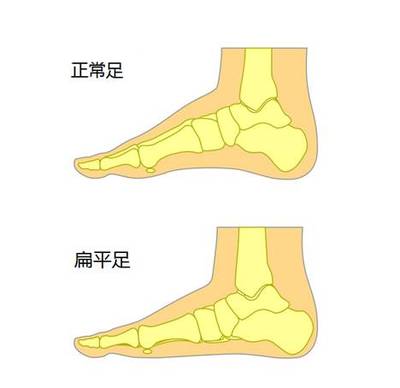 脚底板酸痛是怎么回事