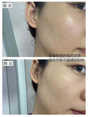 闭口痘痘粗糙
