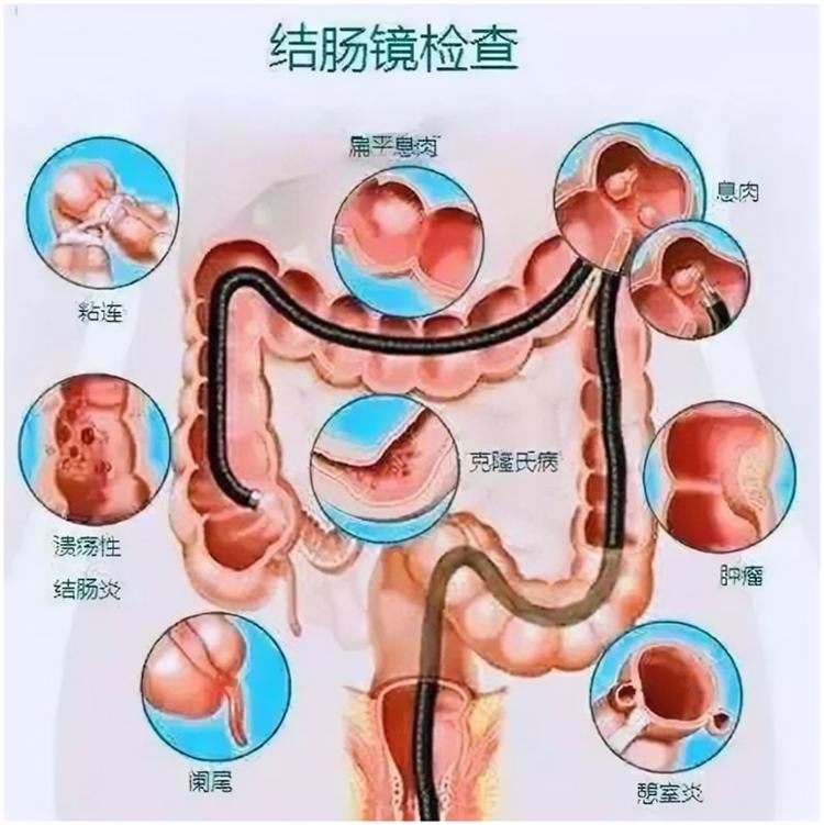 胃粘连怎么治疗方法