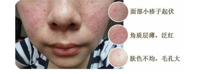 脸部发热是怎么回事