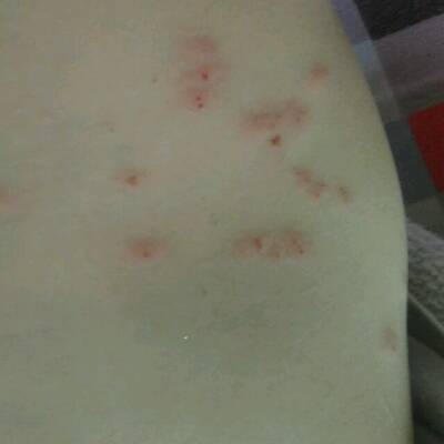 孩子背上起痘痘是怎么回事