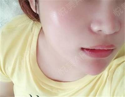 水光针三文鱼和菲洛嘉哪个好