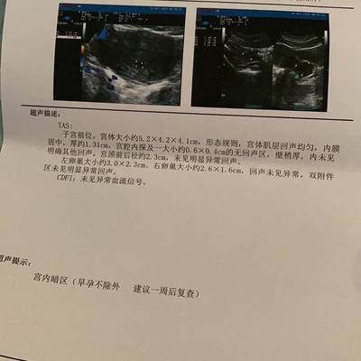 怀孕几天能看到孕囊