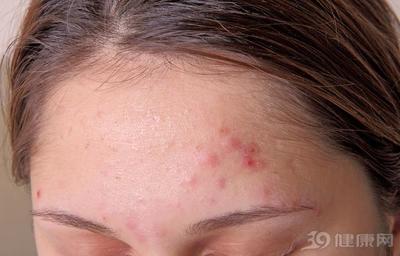 脸上痘痘用哪个身体排毒