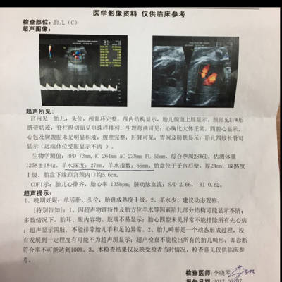 孕29周羊水左右是多少正常