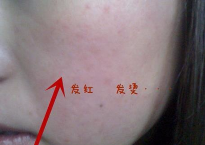 腿上毛孔发红