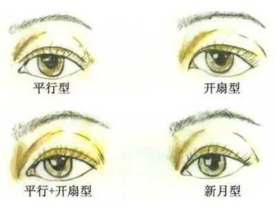 怎么拥有双眼皮