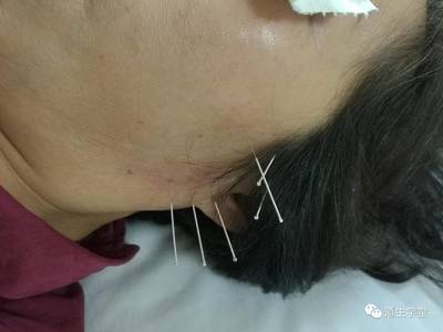 嗓子右边疼是怎么回事