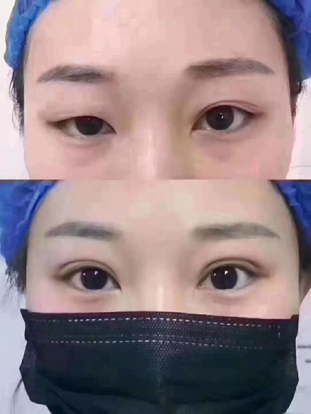 怎样才能有双眼皮