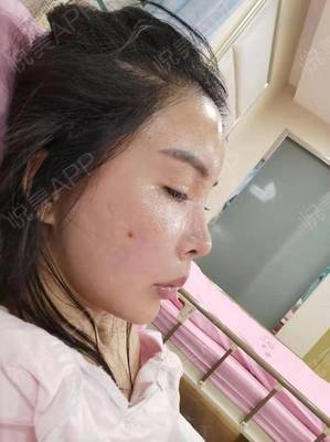 打了玻尿酸要肿多久