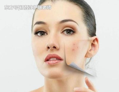 脸上痘印怎么快速消除
