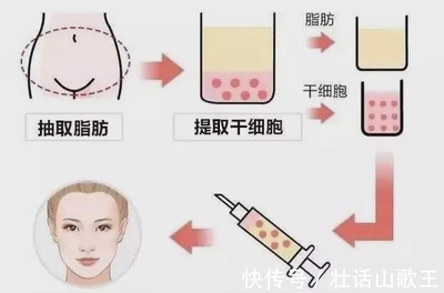 脂肪填充还是玻尿酸好