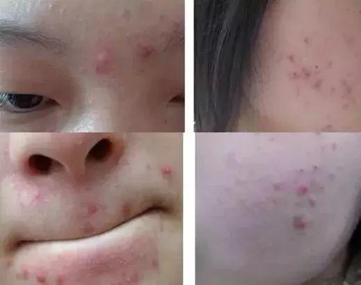 脓包痘痘不挤会自然消