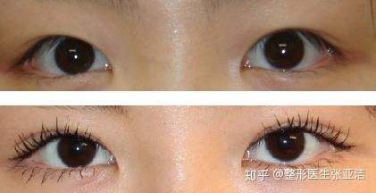 经期做双眼皮