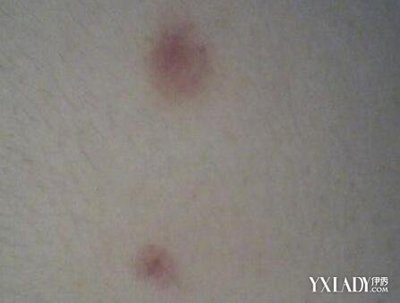 男人背上长痘痘用什么洗