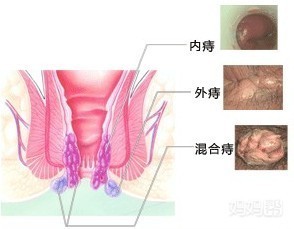 怀孕前要做痔疮手术吗