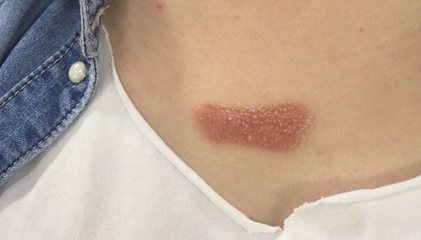 痘痘怎么能治好