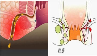 新生儿肛周脓肿图片
