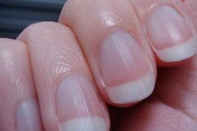 孩子手指甲有竖纹是怎么回事