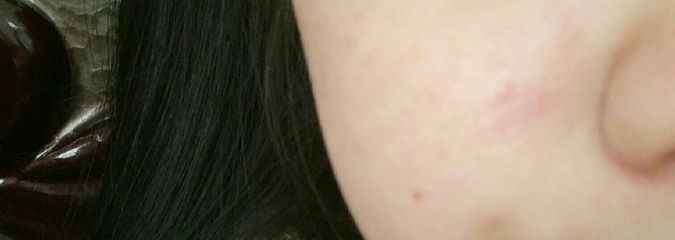 痘印用什么可以消除
