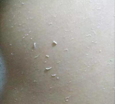 后背毛孔密密麻麻黑点