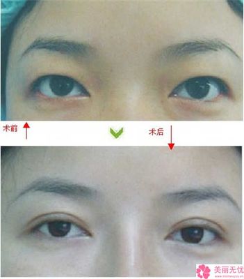 经期做双眼皮