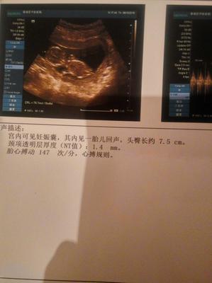 胎儿一般多少天有胎心