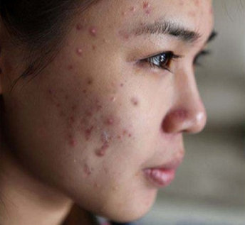 为什么一老长痘痘