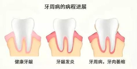 拔牙多久可以好