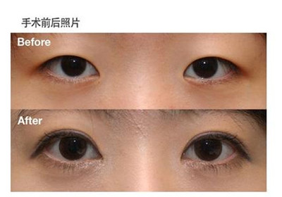双眼皮的遗传