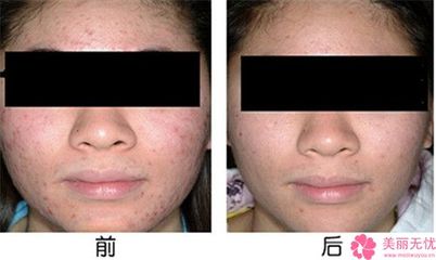 去掉痘痘要多少钱