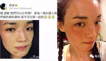 脸上有痘痘适合什么精华