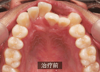 更换牙齿需要多少钱