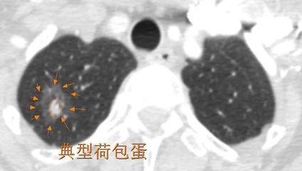 肺结节影是什么意思啊怎么治疗