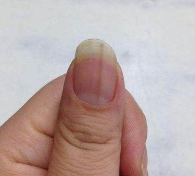 指甲出现竖条纹是怎么回事