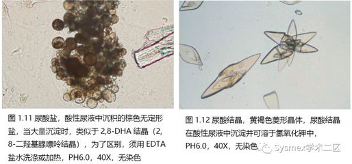 胆固醇结晶是怎么回事