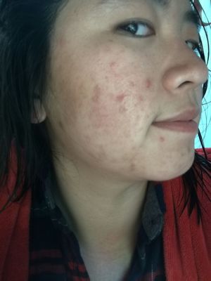 美容院能治疗痘痘吗