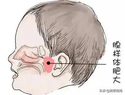 宝宝腺体肥大