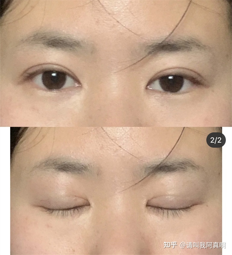 洛阳哪里割双眼皮不错