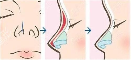假体隆鼻恢复过程