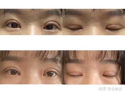 两只眼睛双眼皮不一样