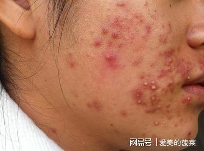激素脸一保湿就爆痘痘