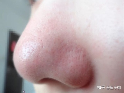 鼻子老是红红的是怎么回事