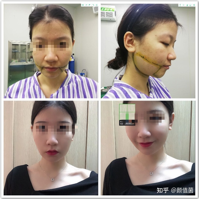 黄金微雕瘦脸