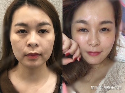 哪抽脂比较好