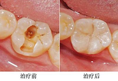 上海补牙多少钱